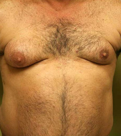 Gynecomastia