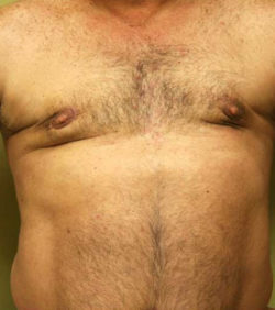 Gynecomastia