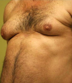 Gynecomastia