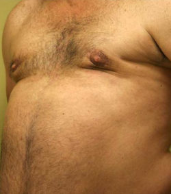 Gynecomastia