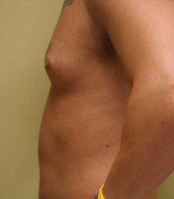 Gynecomastia