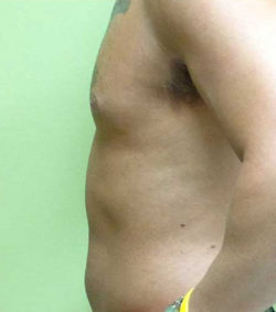 Gynecomastia