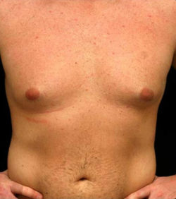 Gynecomastia