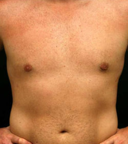 Gynecomastia