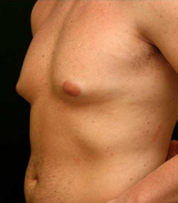 Gynecomastia