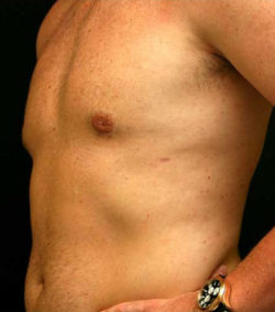 Gynecomastia