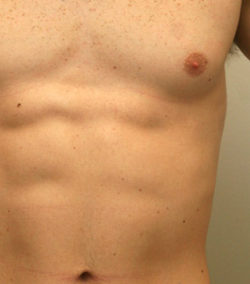 Gynecomastia