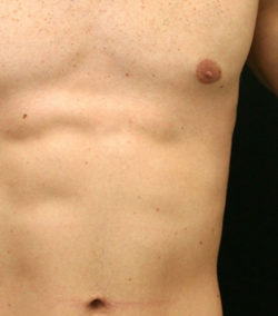 Gynecomastia