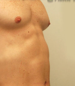 Gynecomastia