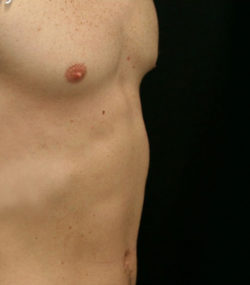 Gynecomastia