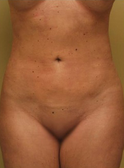 Liposuction