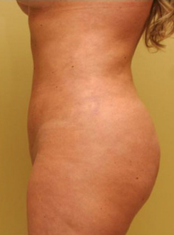 Liposuction