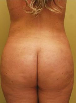 Liposuction
