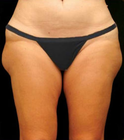 Liposuction