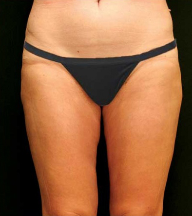 Liposuction