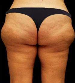 Liposuction