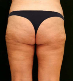 Liposuction