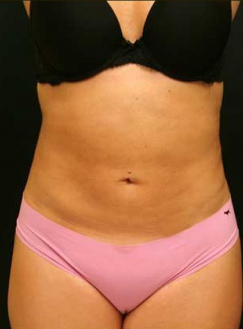 Liposuction