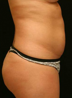 Liposuction