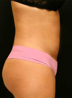 Liposuction