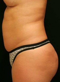 Liposuction