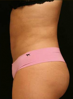 Liposuction