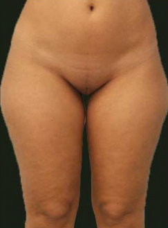 Liposuction