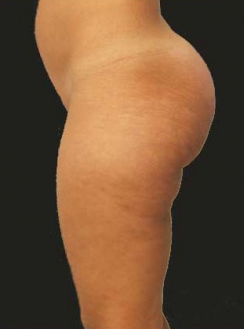 Liposuction