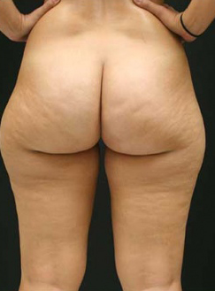 Liposuction