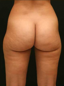 Liposuction