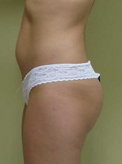 Liposuction