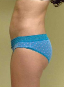 Liposuction