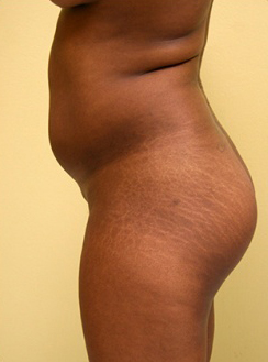 Liposuction