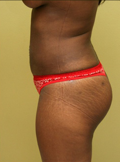 Liposuction