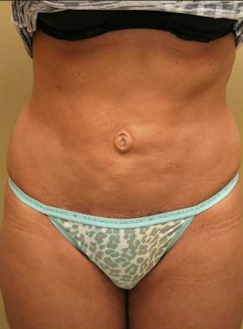 Liposuction