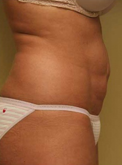 Liposuction