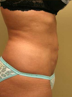 Liposuction