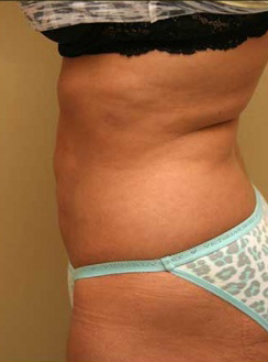 Liposuction