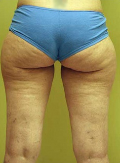 Liposuction