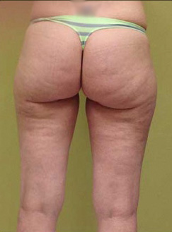 Liposuction