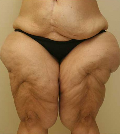 Thigh Lift