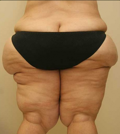 Thigh Lift