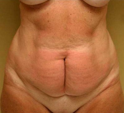Tummy Tuck