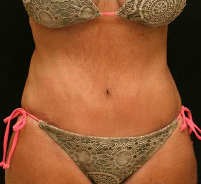 Tummy Tuck