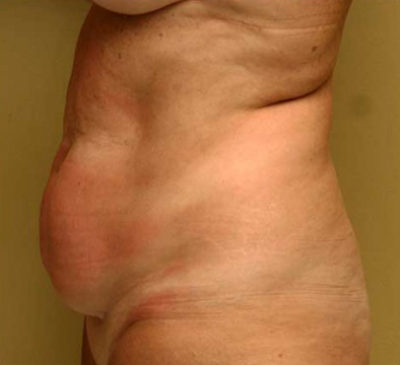 Tummy Tuck