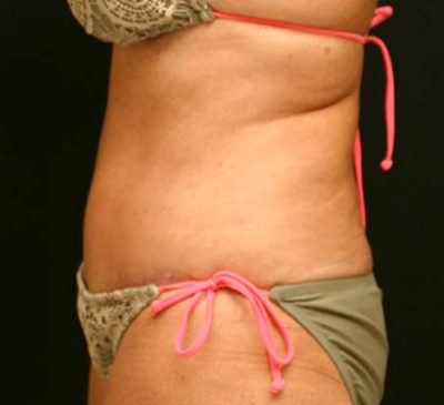 Tummy Tuck