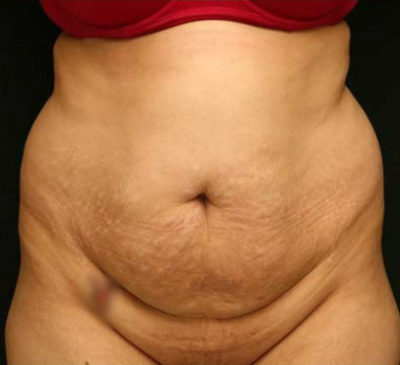 Tummy Tuck
