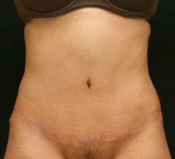 Tummy Tuck