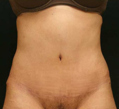 Tummy Tuck