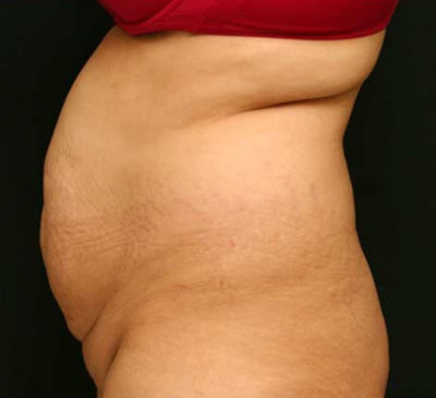 Tummy Tuck